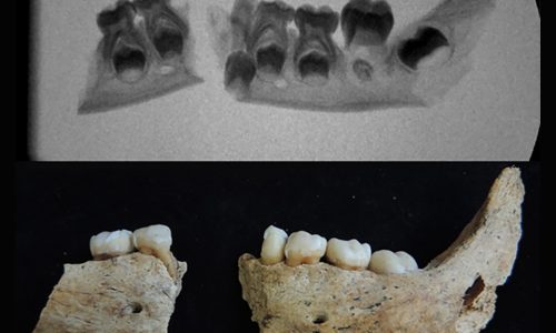 Antropología Dental